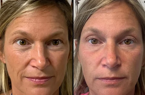 Side-by-side comparison of a woman's face before (left) and after (right) an unspecified treatment, showing differences in skin texture and tone.