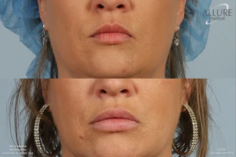 Before and after close-up images of a woman's lips, showcasing the results of a lip filler procedure. The top image shows the lips before the procedure, and the bottom image shows them after.