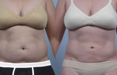 Before and after comparison of two women's midsections, showing changes in body contour and skin tone, both wearing similar undergarments.