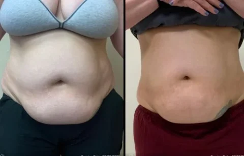 Side-by-side comparison of a person's abdomen before and after a weight loss or shaping intervention.