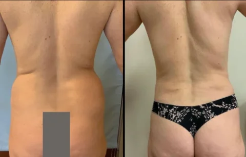 Before and after comparison of a person's back showing reduced fat and improved contour, with the person wearing different undergarments in each image.