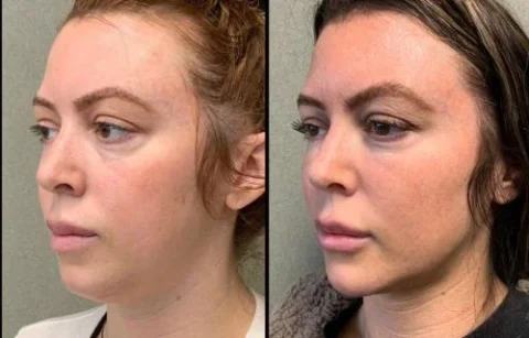 Side-by-side comparison of a woman's face before and after a cosmetic procedure. The left image shows a fuller appearance while the right image shows a more contoured jawline.