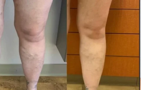 A side-by-side comparison of legs showing the appearance before and after a treatment, with visible reduction in blemishes.