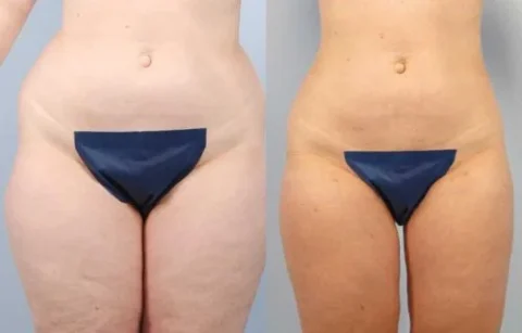 Before and after image showing body contouring results on a person's lower abdomen and thighs, with noticeable reduction in size.